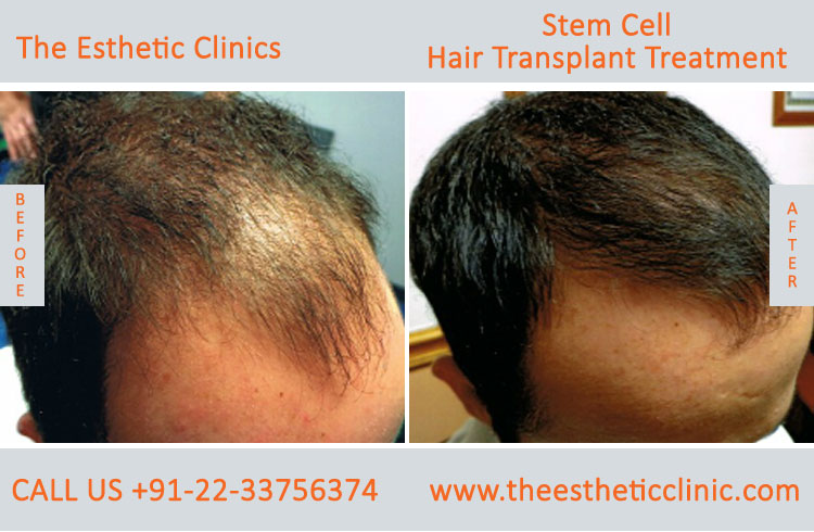 Stem Cell Hair Transplant Treatment before after photos in mumbai india (6)